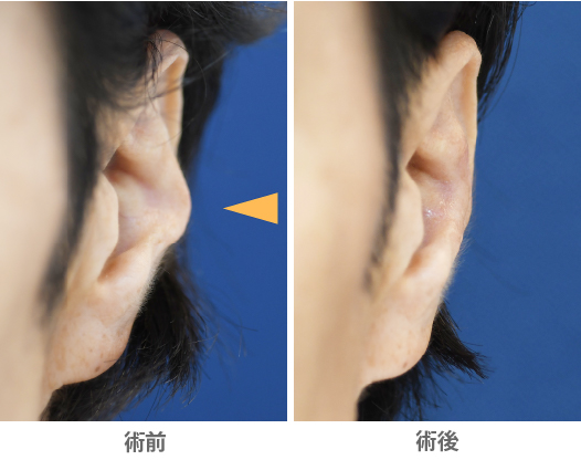 「対耳輪修正術（耳のフチにある軟骨の突出を修正する）」の症例写真・ビフォーアフター