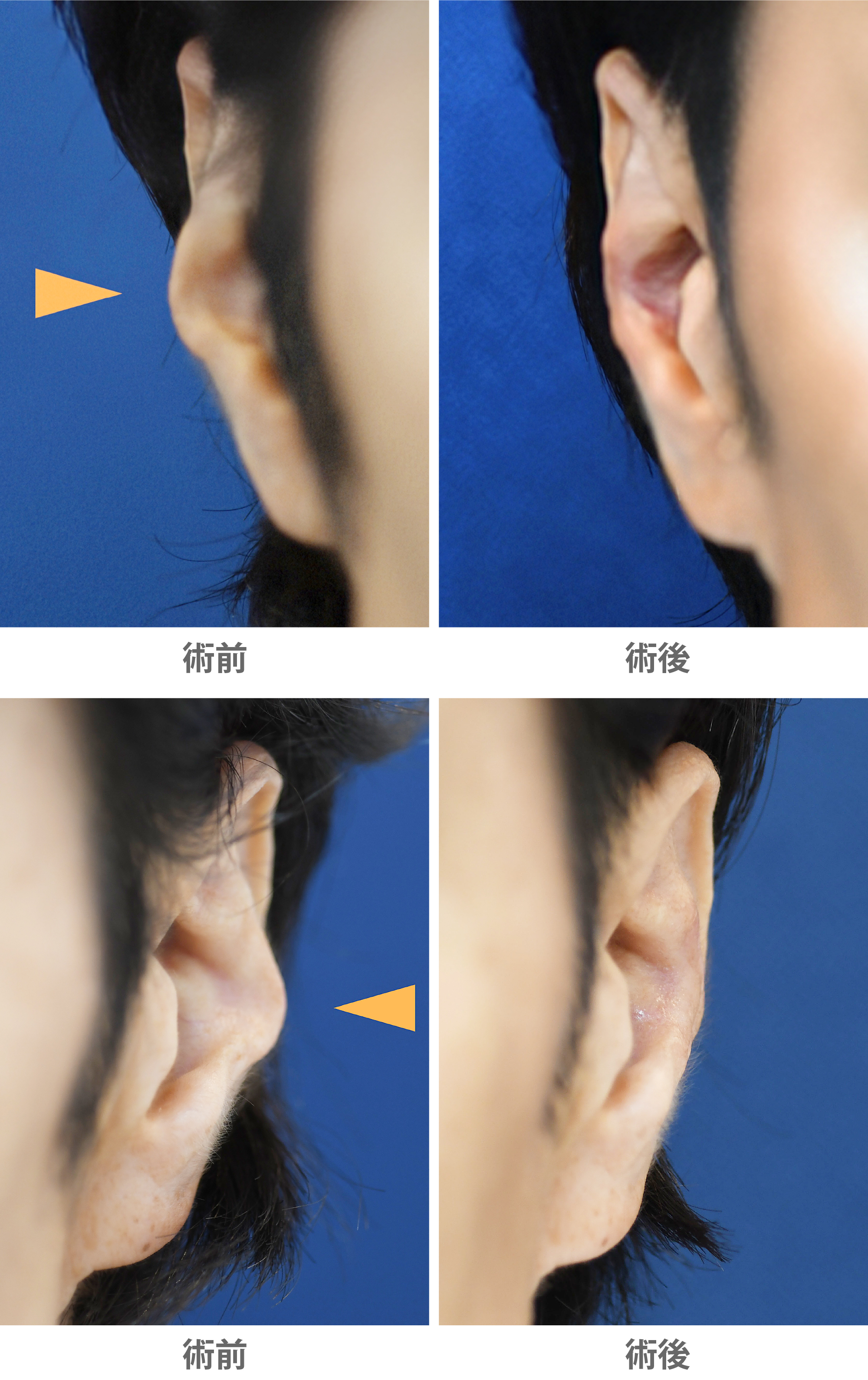 「対耳輪修正術(耳のフチにある軟骨の突出を修正する)」の症例写真・ビフォーアフター