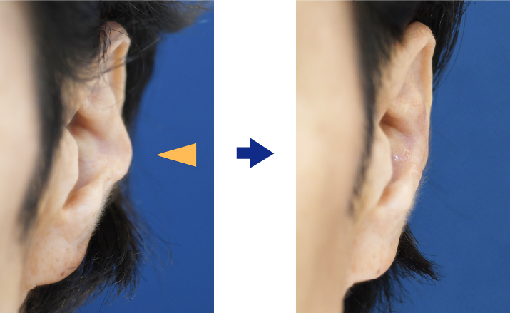 対耳輪修正術(対耳輪の突出を改善する)