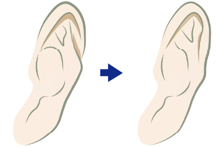 対耳輪修正術とは