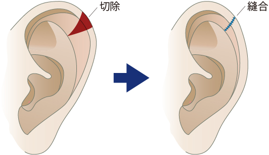 耳輪縮小術・忘れ耳整形