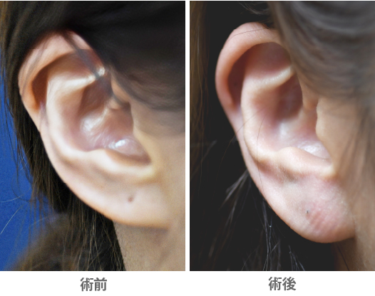 「耳垂プロテーゼ（耳たぶを大きくする／福耳整形）」の症例写真・ビフォーアフター