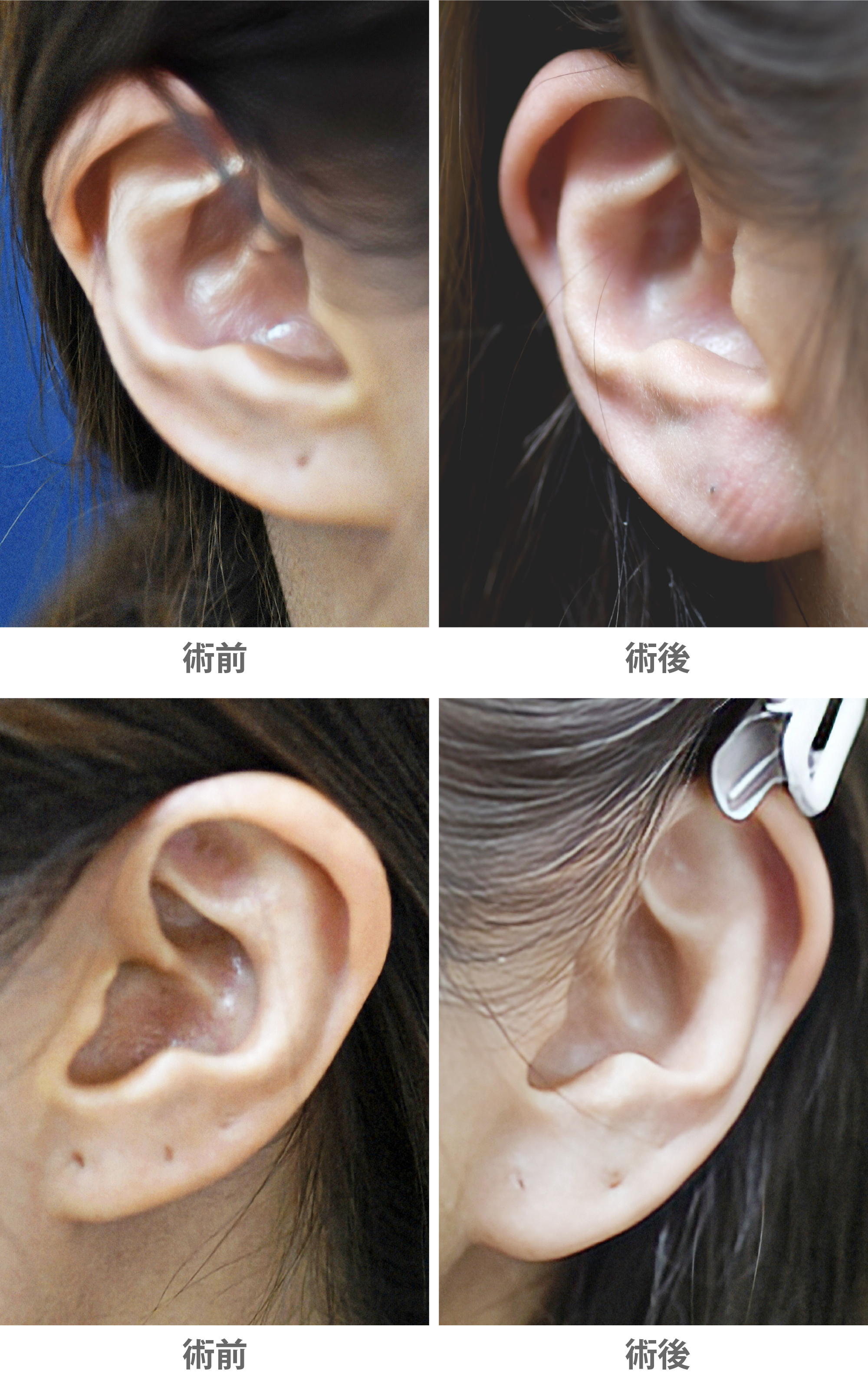 「耳垂プロテーゼ(耳たぶを大きくする/福耳整形)」の症例写真・ビフォーアフター