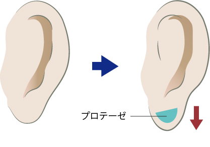 耳垂プロテーゼの施術パターンA（縦方向を意識した伸長手術）