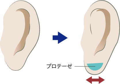 耳垂プロテーゼの施術パターンB（横幅方向を意識した拡張手術）