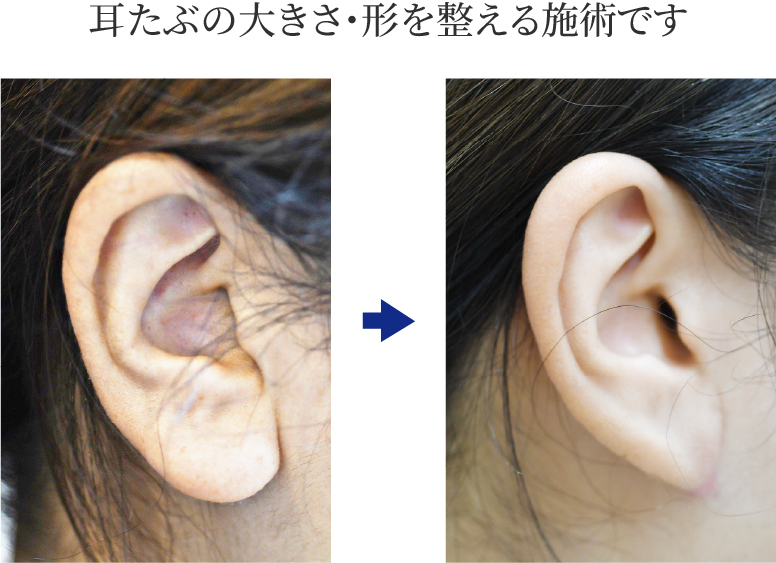 耳たぶの大きさ・形を整える施術です