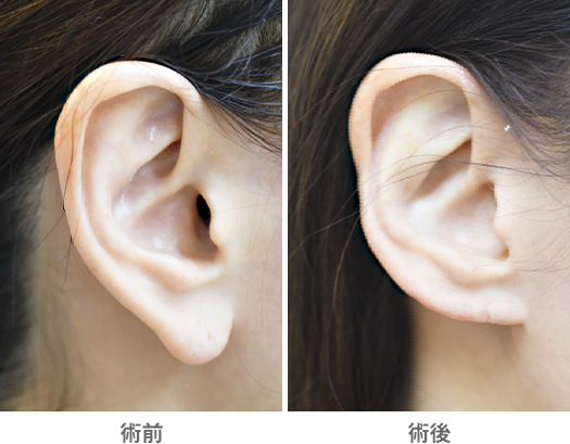 「耳垂縮小術（耳たぶを小さく見せる耳形成術）」の症例写真・ビフォーアフター