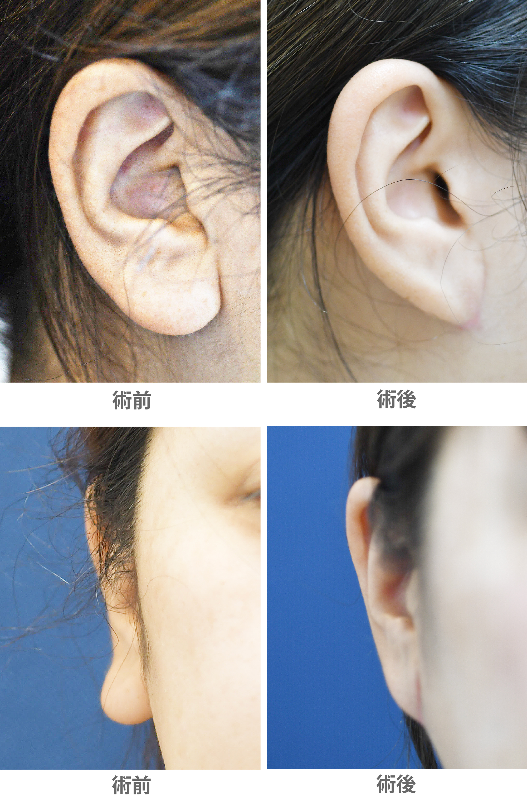 「耳垂縮小術・縦切除法(耳たぶを小さくする)」の症例写真・ビフォーアフター