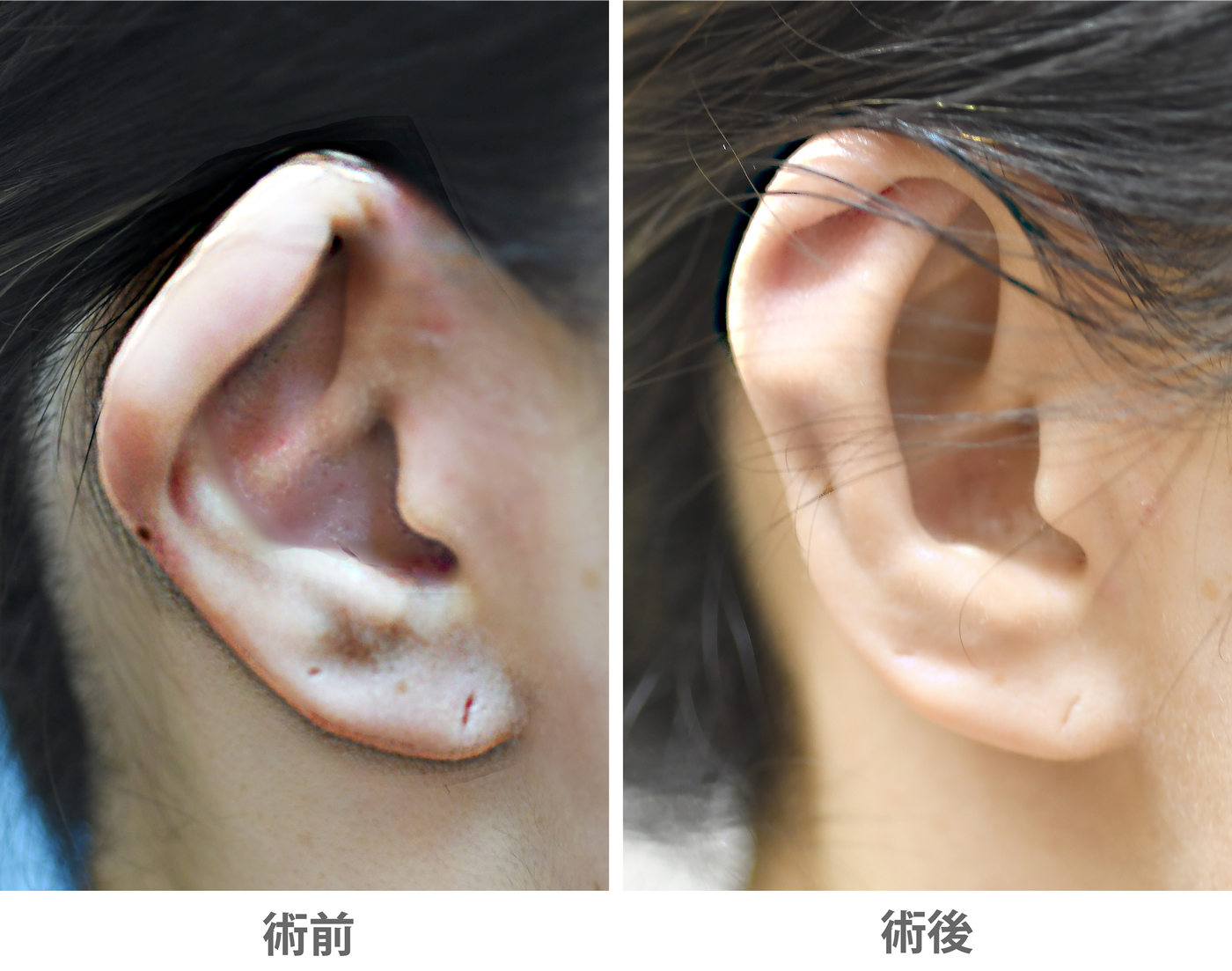 「折れ耳修正術(中等症)」の症例写真・ビフォーアフター