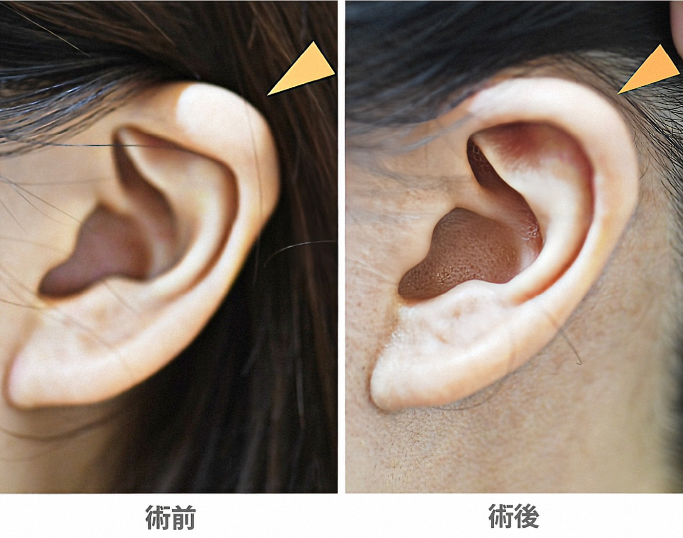 「折れ耳修正術（軟骨切除法）」の症例写真・ビフォーアフター