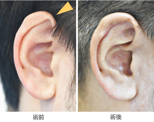 「耳輪形成術（尖り耳修正／尖り感のある耳を滑らかにする）」の症例写真・ビフォーアフター
