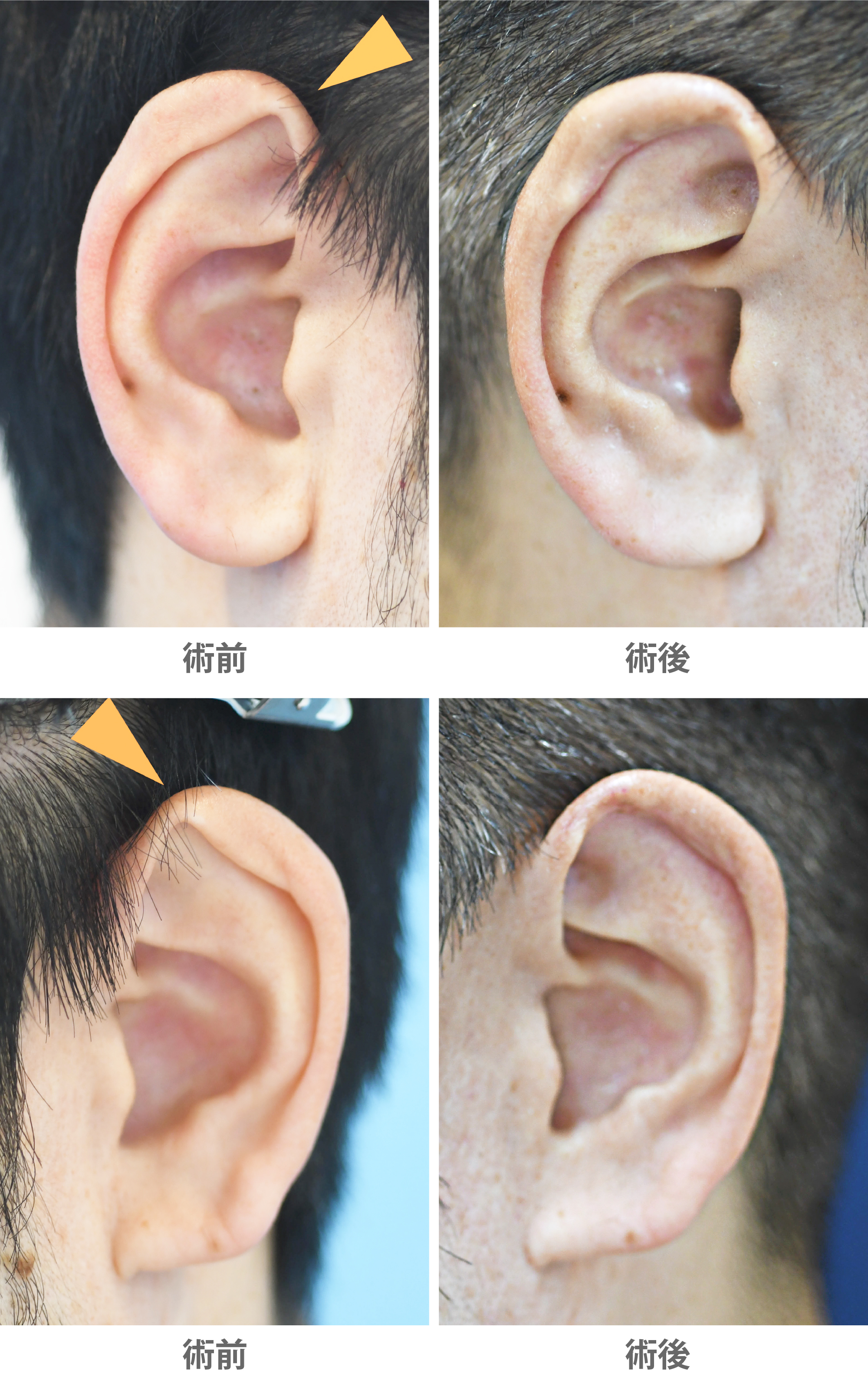 「耳輪形成術（尖り耳修正／尖り感のある耳を滑らかにする）」の症例写真・ビフォーアフター