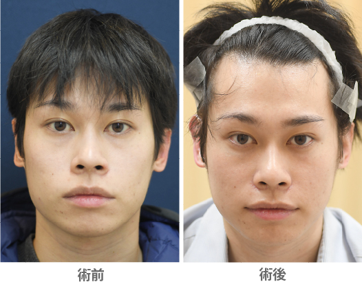 「立ち耳整形（片耳／左右差改善）」の症例写真・ビフォーアフター