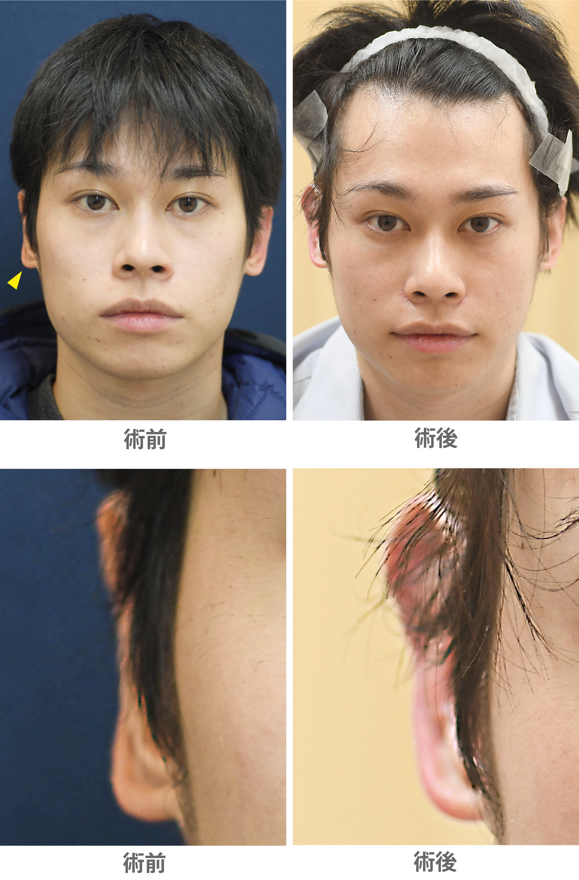 「立ち耳整形（片耳／左右差改善）」の症例写真・ビフォーアフター