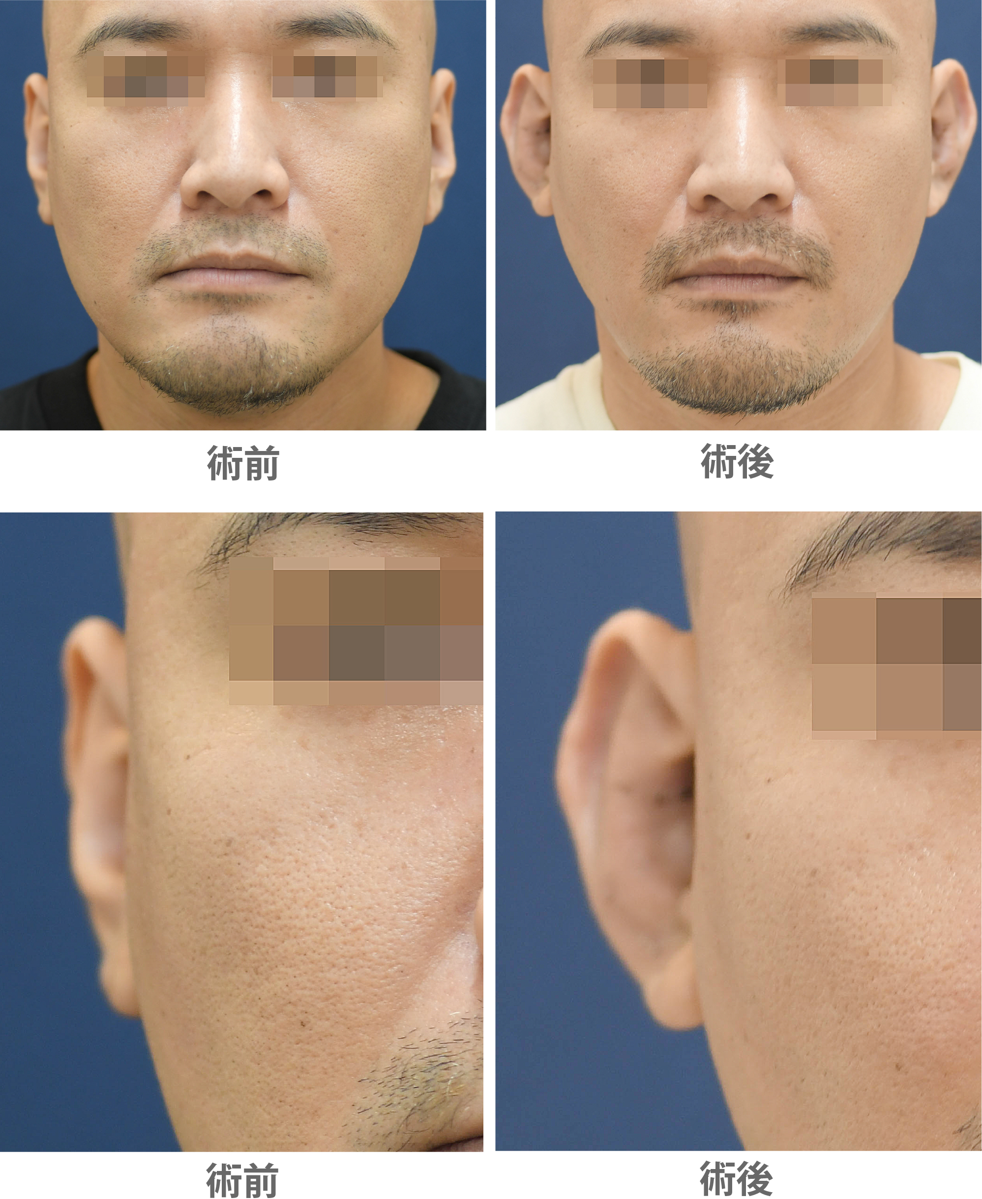 「立ち耳整形(片耳/左右差改善)」の症例写真・ビフォーアフター