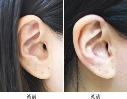 「耳縮小術（忘れ耳整形・耳輪舟状窩切除法）」の症例写真・ビフォーアフター