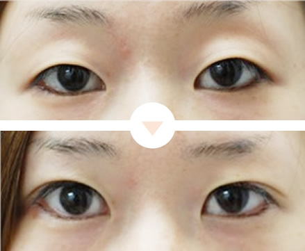 一重を二重まぶたにしたい