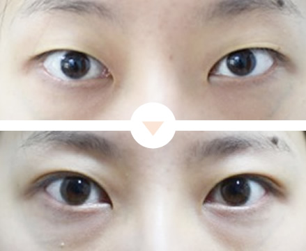 末広型の二重にしたい
