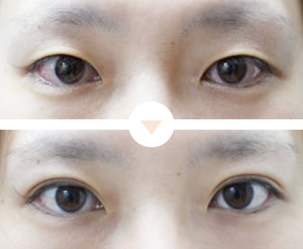 平行型の二重にしたい