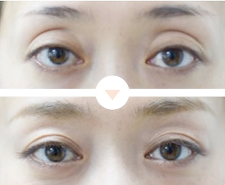 眠そうな目元を改善したい