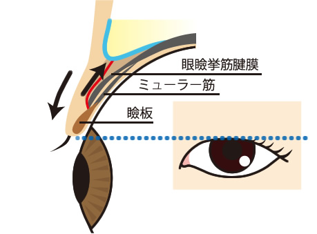 一重まぶたの構造