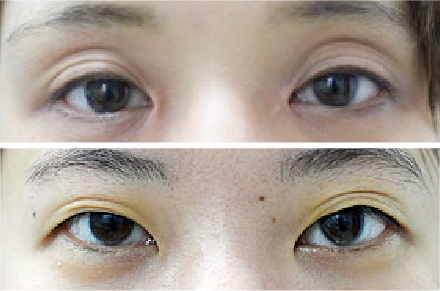 三重まぶた改善治療