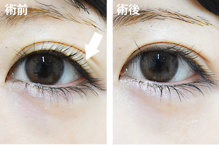 ②二重ラインの「下側」のラインを消す