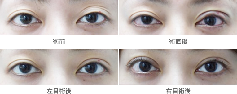 「三重まぶた改善治療（ヒアルロン酸＋眼瞼下垂手術）」の症例写真・ビフォーアフター