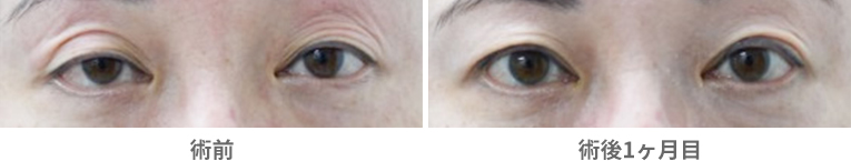 「三重まぶた改善治療（眼瞼下垂手術の応用）」の症例写真・ビフォーアフター