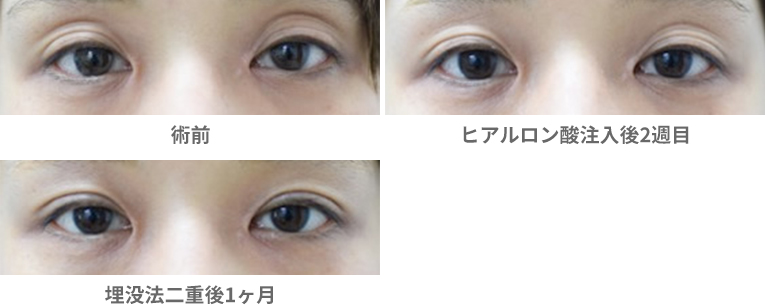 「三重まぶたと目の上のくぼみ治療（ヒアルロン酸＋二重埋没法）」の症例写真・ビフォーアフター