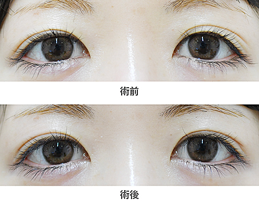 「三重まぶた改善治療（皮膚切除のみ）」の症例写真・ビフォーアフター