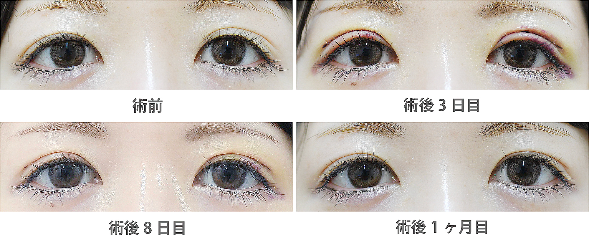 「三重まぶた改善治療(皮膚切除のみ)」の症例写真・ビフォーアフター