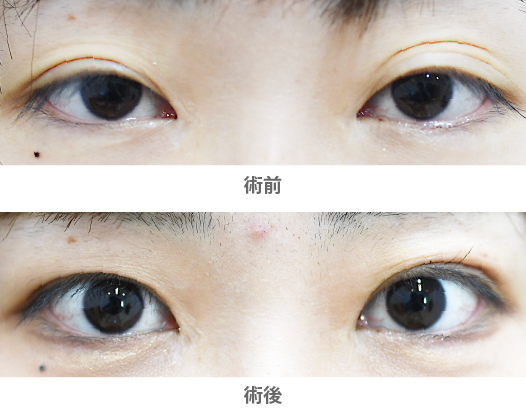 「三重まぶた改善治療（ROOF切除）」の症例写真・ビフォーアフター