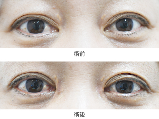 「目頭形成（蒙古襞形成）」の症例写真・ビフォーアフター