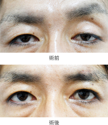 「眼瞼下垂手術／大腿筋膜移植（先天性眼瞼下垂）」の症例写真・ビフォーアフター