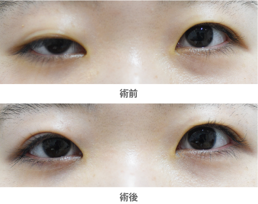 「眼瞼下垂手術／大腿筋膜移植（先天性眼瞼下垂）」の症例写真・ビフォーアフター