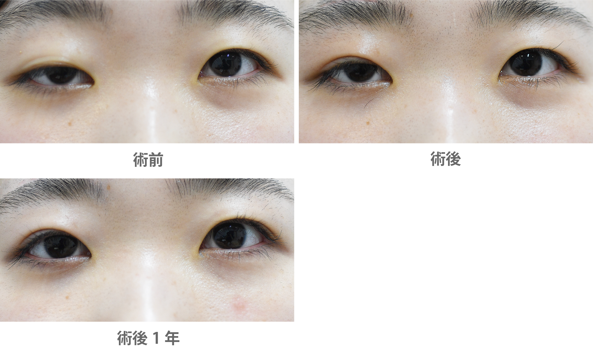 「眼瞼下垂手術／大腿筋膜移植（先天性眼瞼下垂）」の症例写真・ビフォーアフター