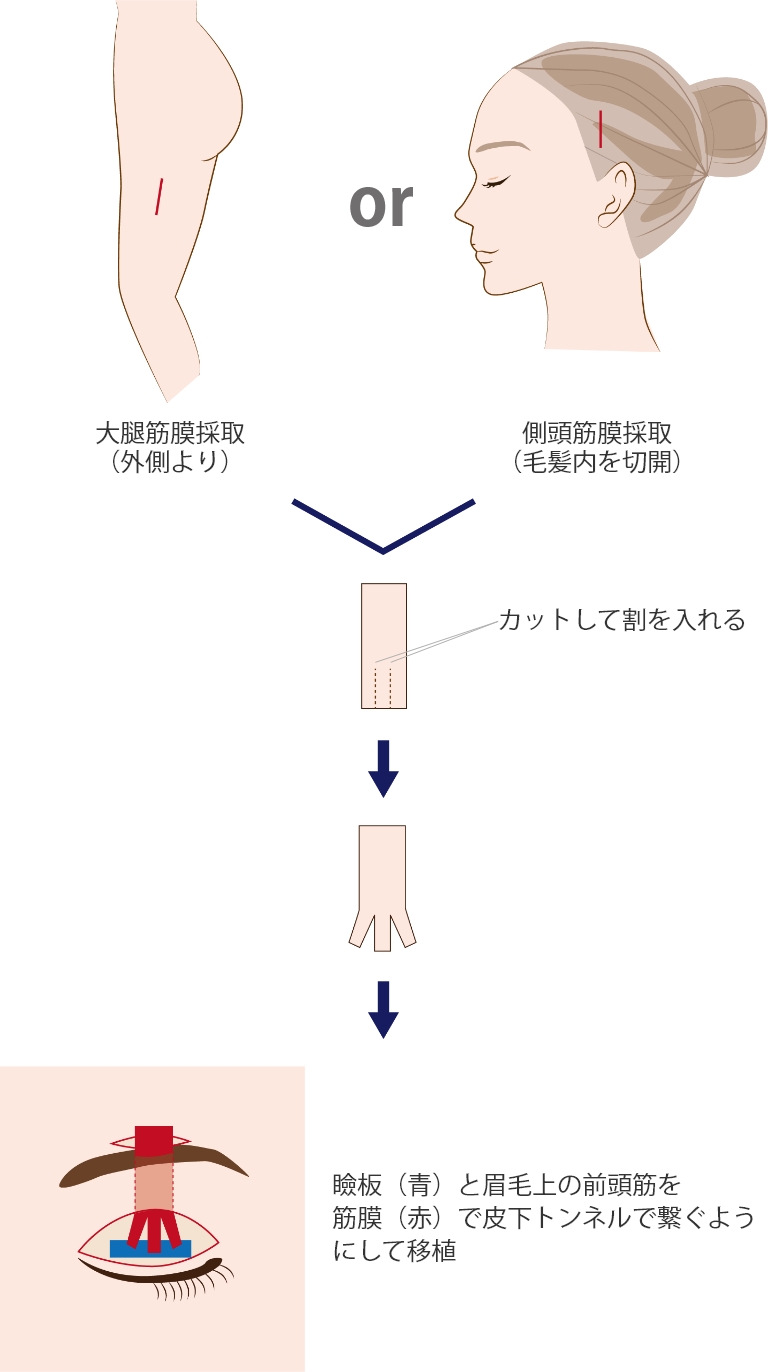 大腿筋膜採取or側頭筋膜採取