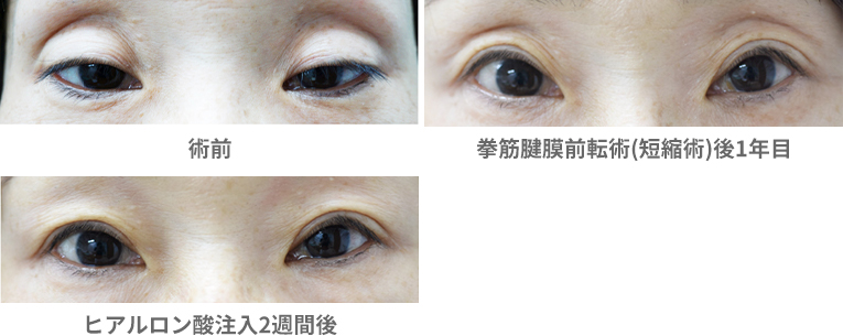 「眼瞼下垂手術（腱膜前転法）・自由診療」の症例写真・ビフォーアフター
