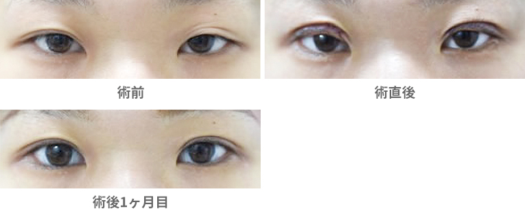 「眼瞼下垂手術（腱膜前転法）・自由診療」の症例写真・ビフォーアフター