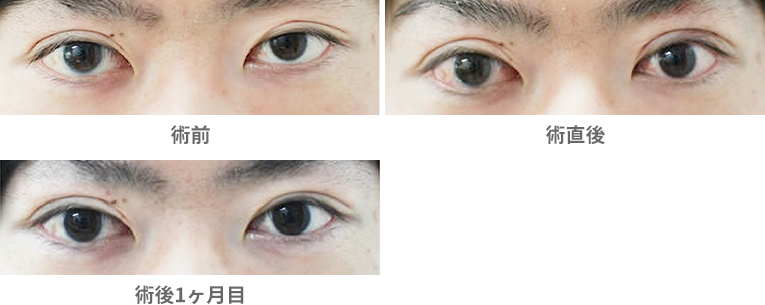 「眼瞼下垂手術（挙筋腱膜前転法）・自由診療」の症例写真・ビフォーアフター