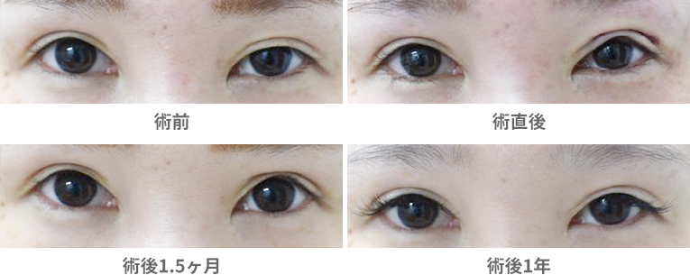 「眼瞼下垂治療（先天性＋医原性のケース）」の症例写真・ビフォーアフター