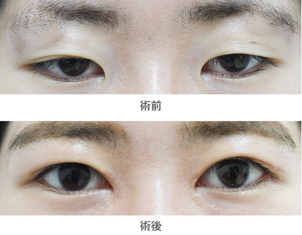 「複合手術（目元を大きく｜眼瞼下垂術＋目尻切開＋目頭切開）」の症例写真・ビフォーアフター