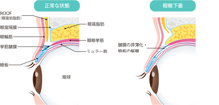 眼瞼下垂の原因