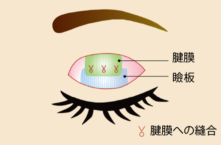 切開を伴う眼瞼下垂術（眼瞼挙筋前転法）