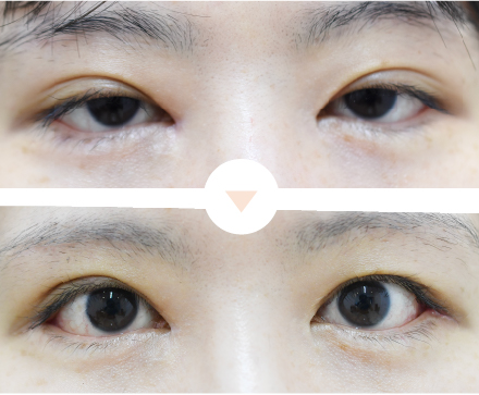 平行型のパッチリ二重にする