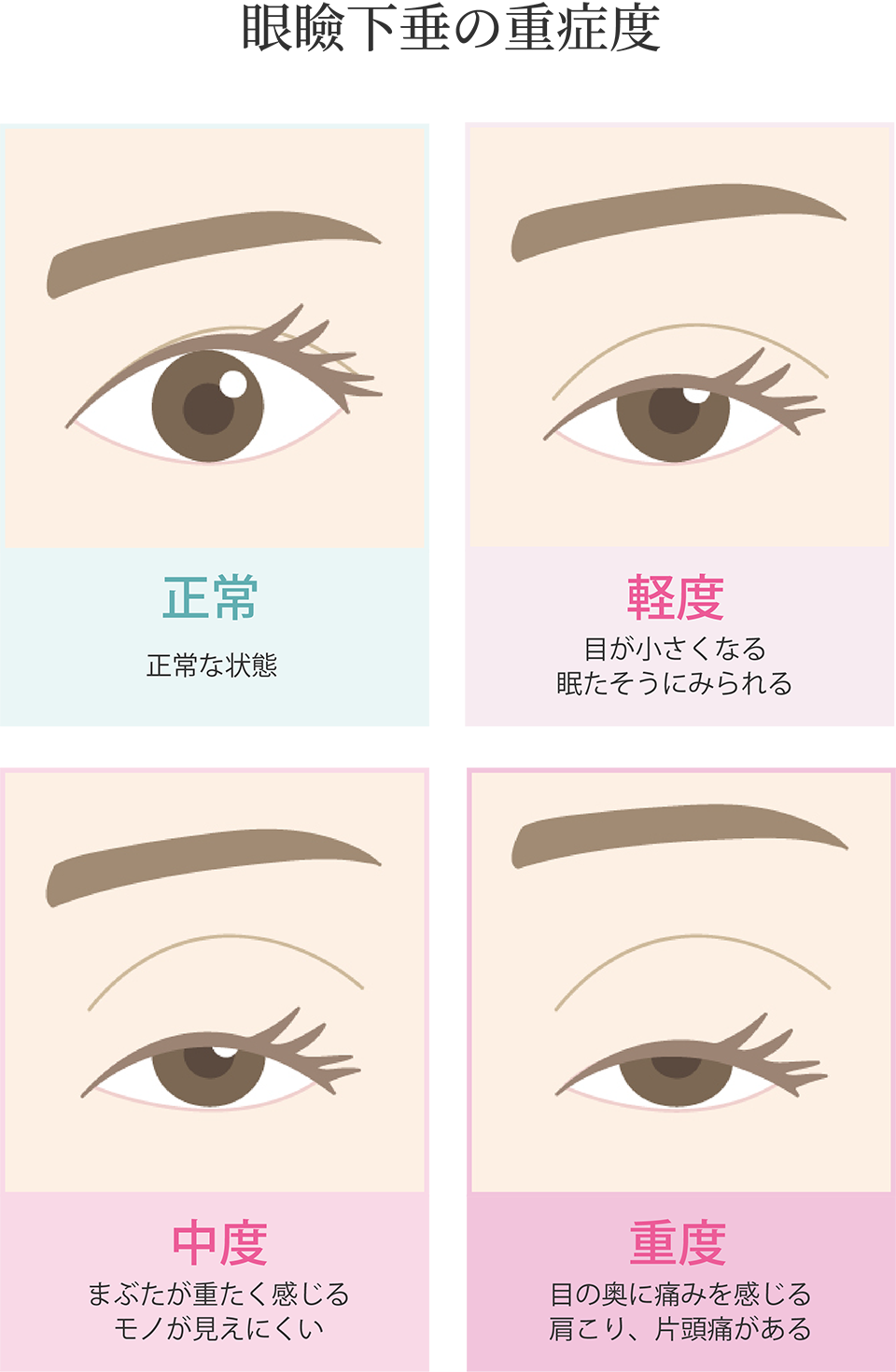 眼瞼下垂の重症度