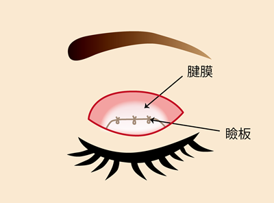 眼瞼挙筋前転法