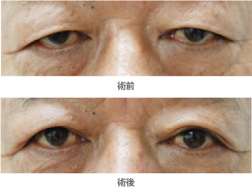 「眼瞼下垂・皮膚性＋腱膜性（保険適用）」の症例写真・ビフォーアフター