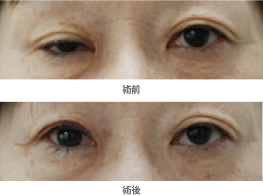 「眼瞼下垂・挙筋腱膜短縮法（保険適用）」の症例写真・ビフォーアフター